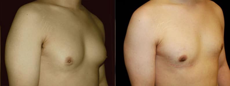 Gynecomastia Patient 7 Before & After Details