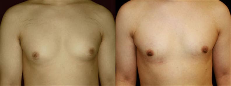 Gynecomastia Patient 7 Before & After