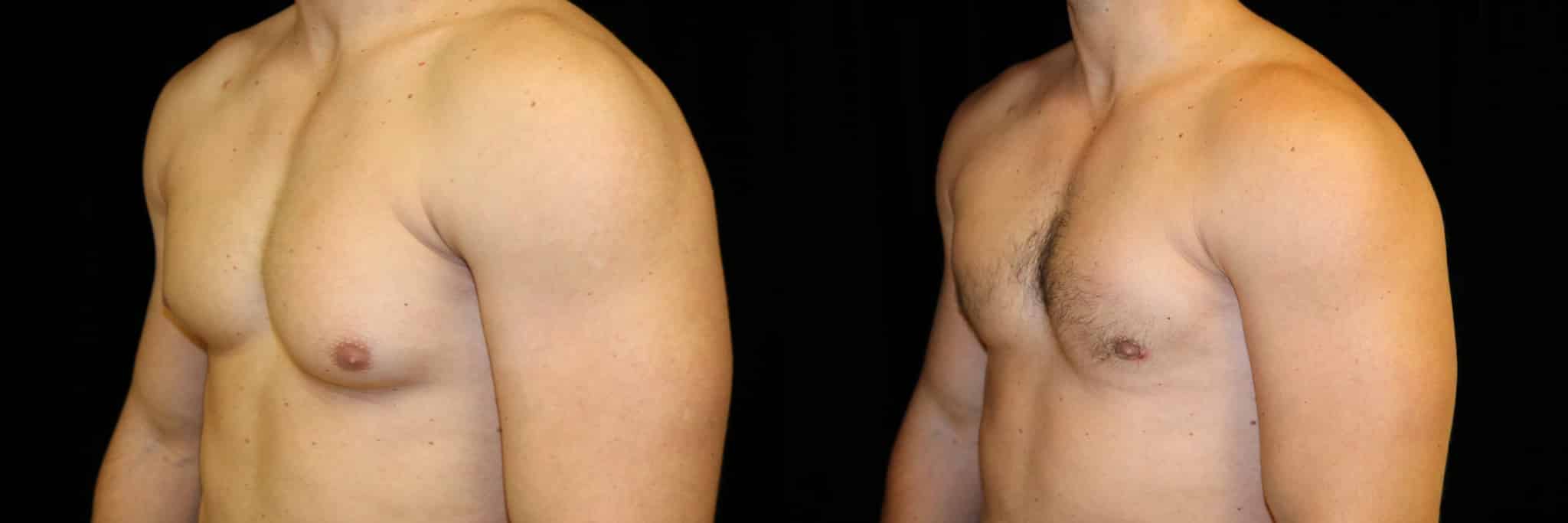 Gynecomastia Patient 19 Before & After Details