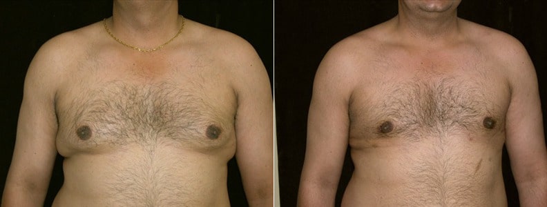 Gynecomastia Patient 16 Before & After