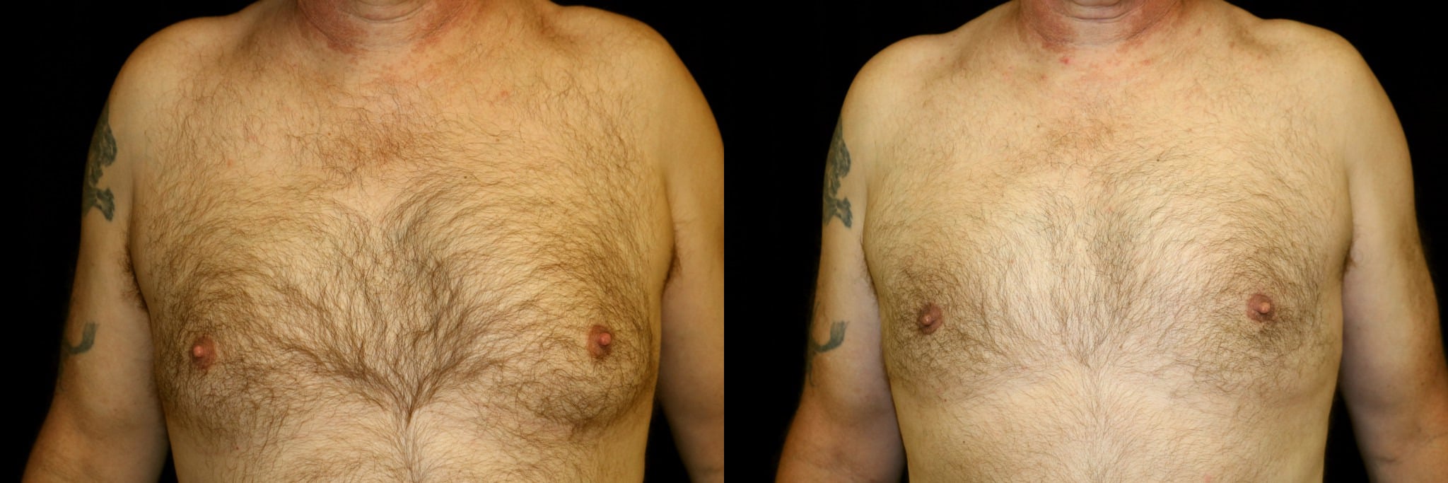 Gynecomastia Patient 17 Before & After