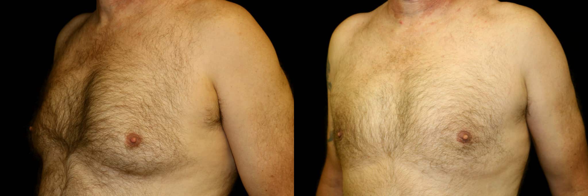 Gynecomastia Patient 17 Before & After Details