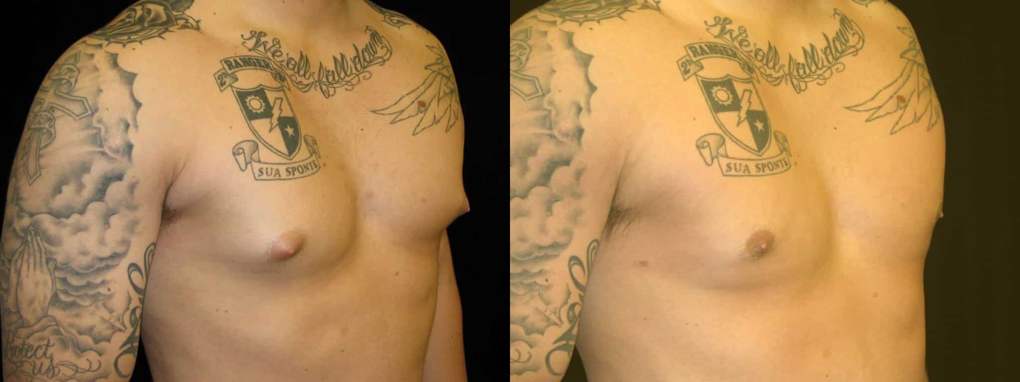 Gynecomastia Patient 8 Before & After Details