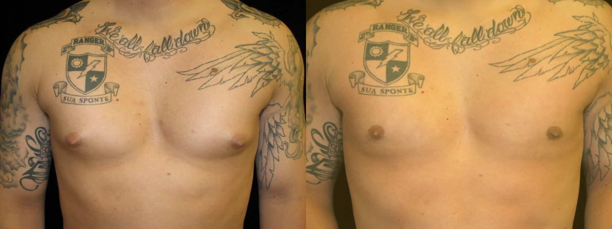 Gynecomastia Patient 8 Before & After