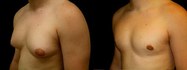 Gynecomastia Patient 5 Before & After Details