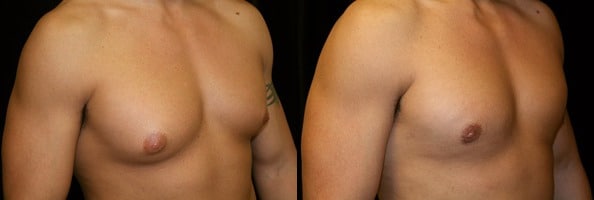 Gynecomastia Patient 2 Before & After Details