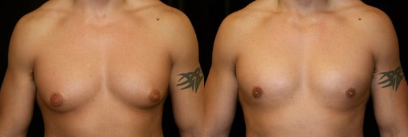 Gynecomastia Patient 2 Before & After