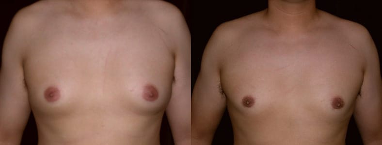 Gynecomastia Patient 9 Before & After