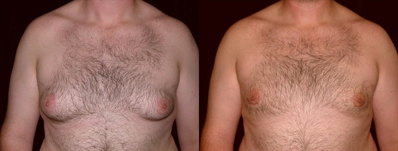 Gynecomastia Patient 4 Before & After