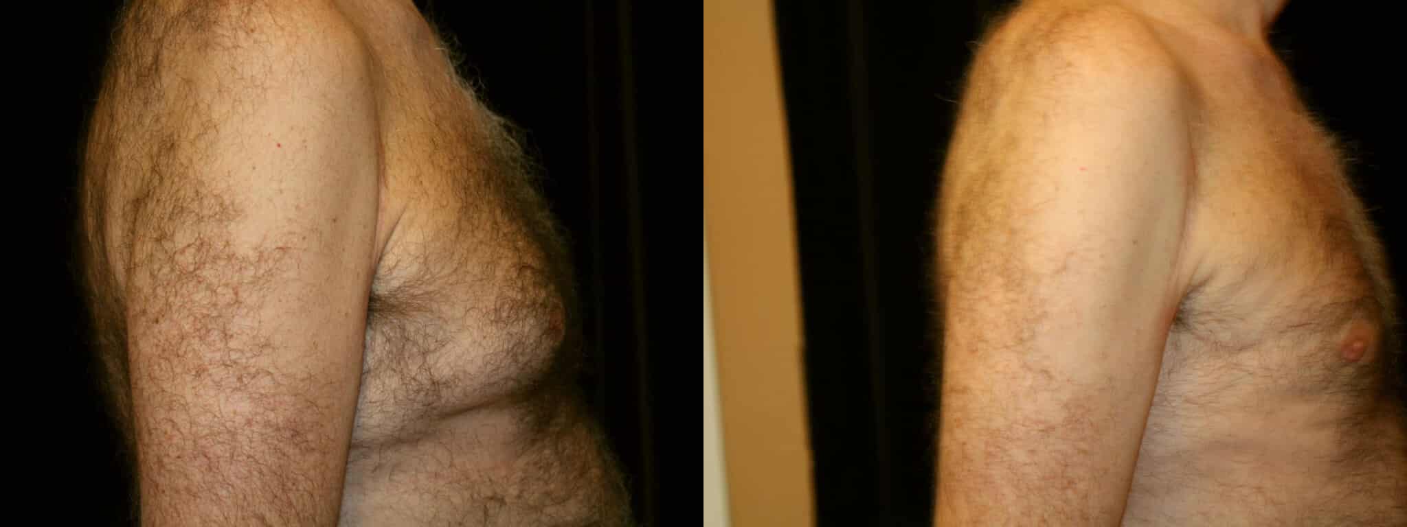 Gynecomastia Patient 15 Before & After Details