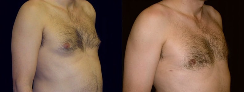 Gynecomastia Patient 11 Before & After