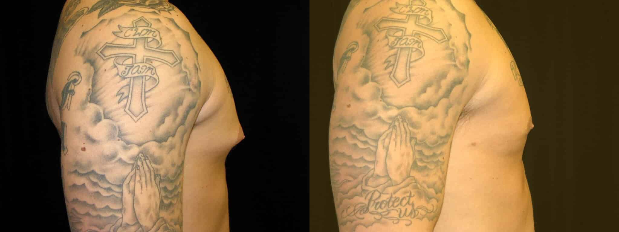 Gynecomastia Patient 8 Before & After Details