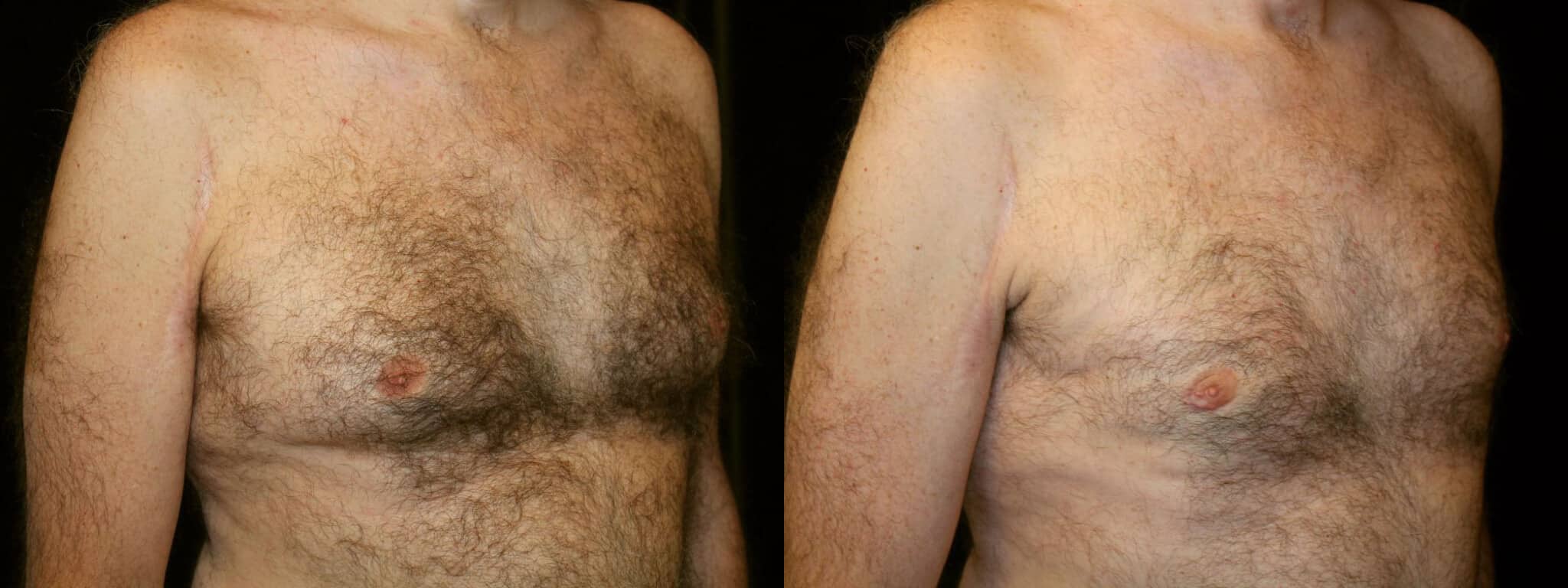 Gynecomastia Patient 15 Before & After Details