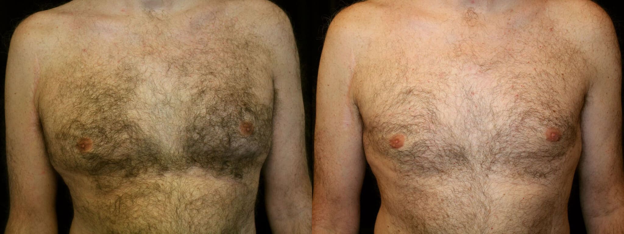 Gynecomastia Patient 15 Before & After