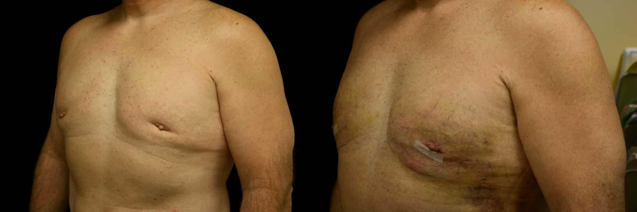 Gynecomastia Patient 2 Before & After Details