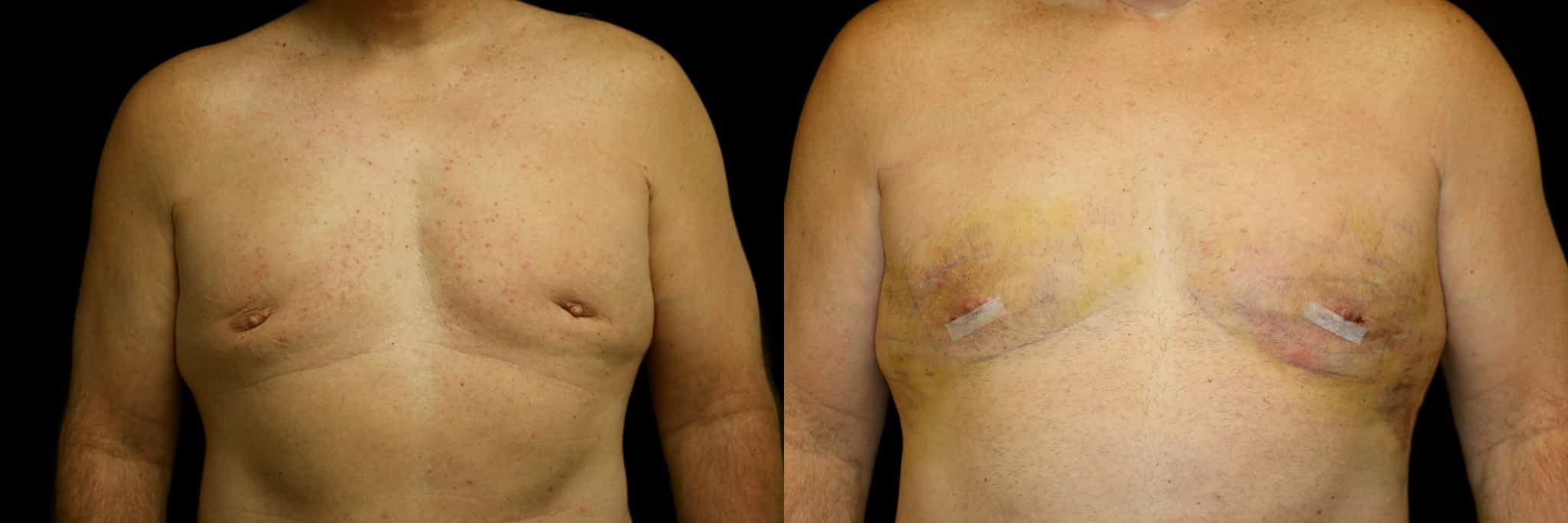 Gynecomastia Patient 2 Before & After