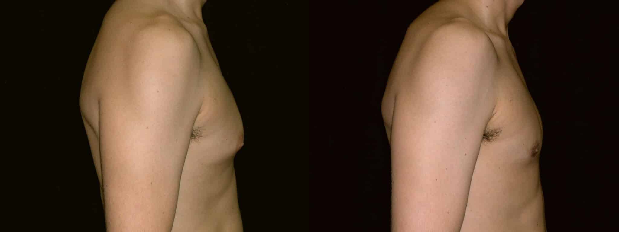 Gynecomastia Patient 4 Before & After Details