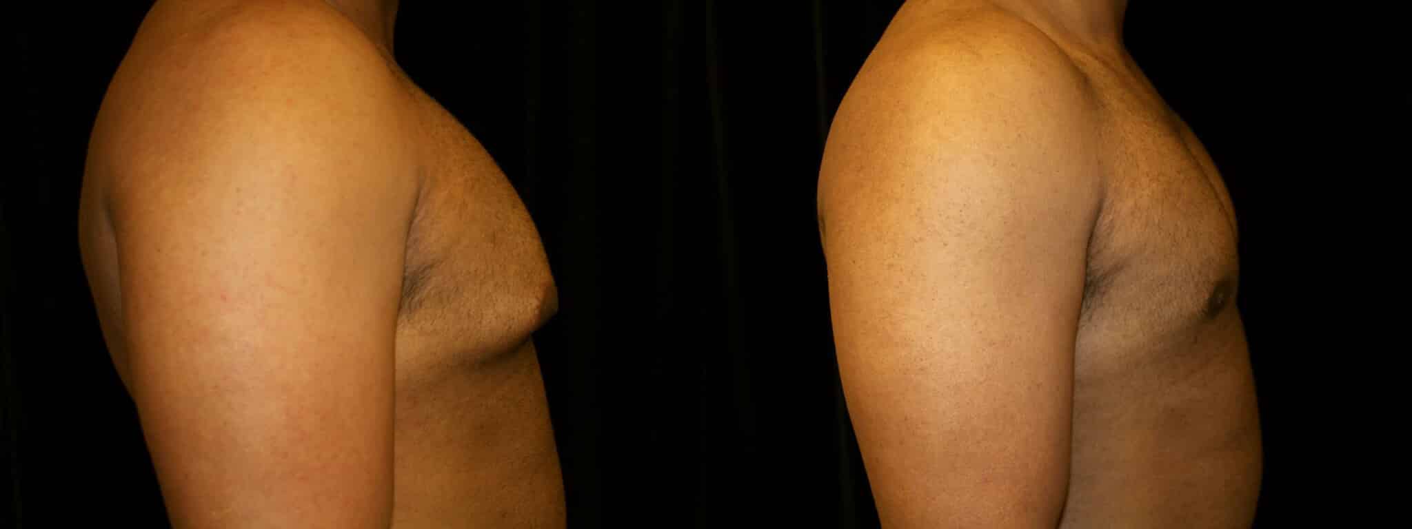 Gynecomastia Patient 10 Before & After Details