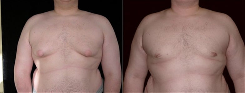 Gynecomastia Patient 14 Before & After