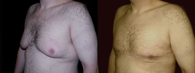 Gynecomastia Patient 19 Before & After Details