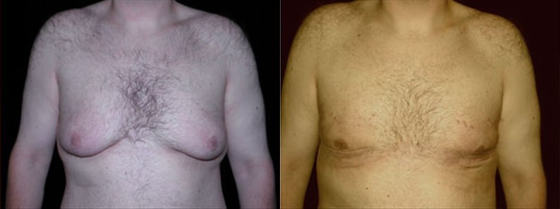 Gynecomastia Patient 19 Before & After