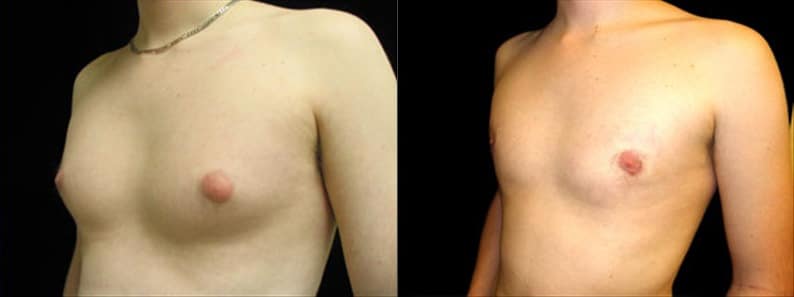 Gynecomastia Patient 1 Before & After Details