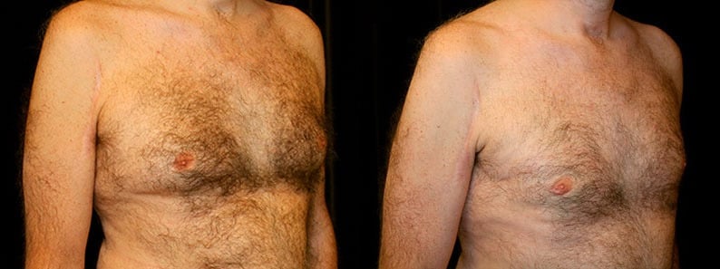 Gynecomastia Patient 3 Before & After Details