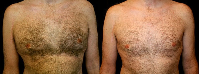 Gynecomastia Patient 3 Before & After