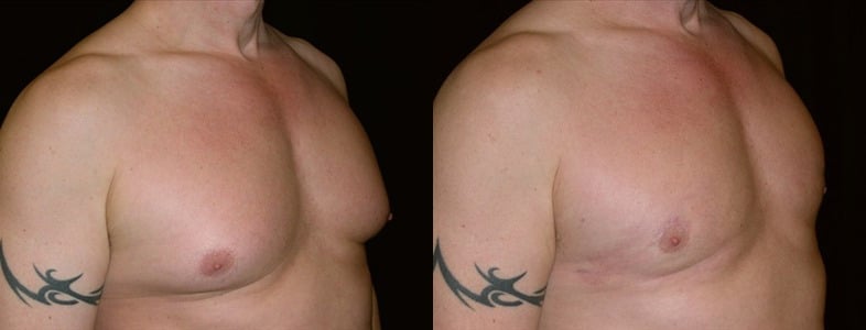 Gynecomastia Patient 9 Before & After