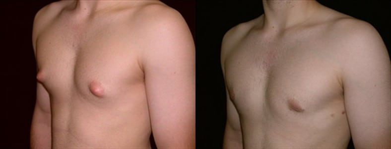 Gynecomastia Patient 14 Before & After