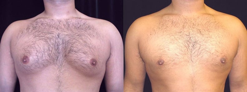 Gynecomastia Patient 4 Before & After