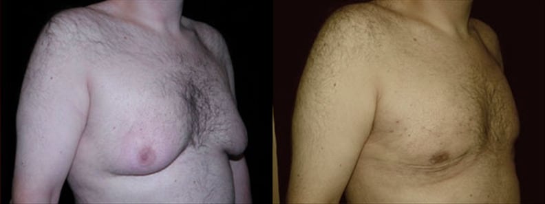 Gynecomastia Patient 19 Before & After Details
