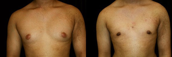 Gynecomastia Patient 11 Before & After