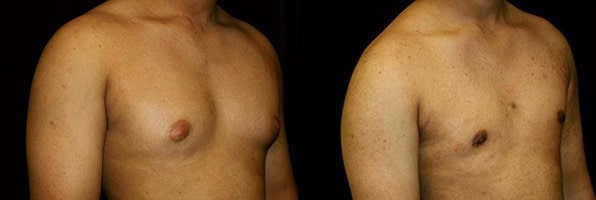 Gynecomastia Patient 11 Before & After Details