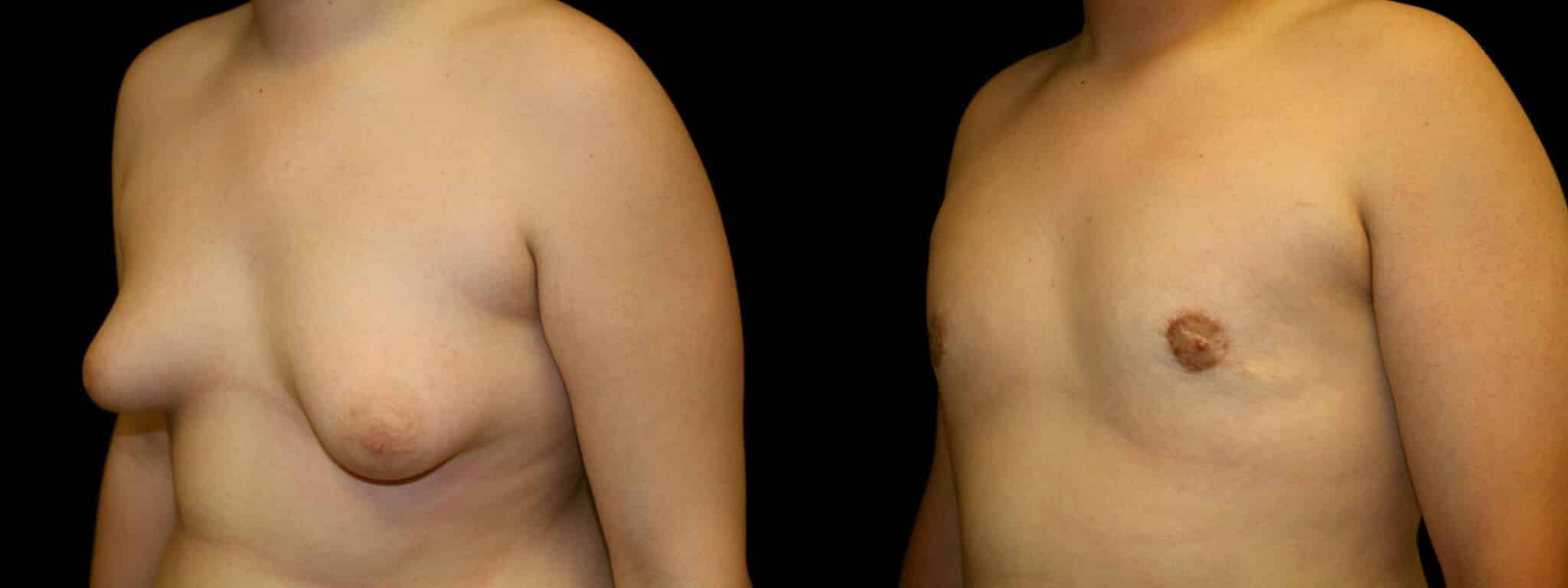 Gynecomastia Patient 2 Before & After Details