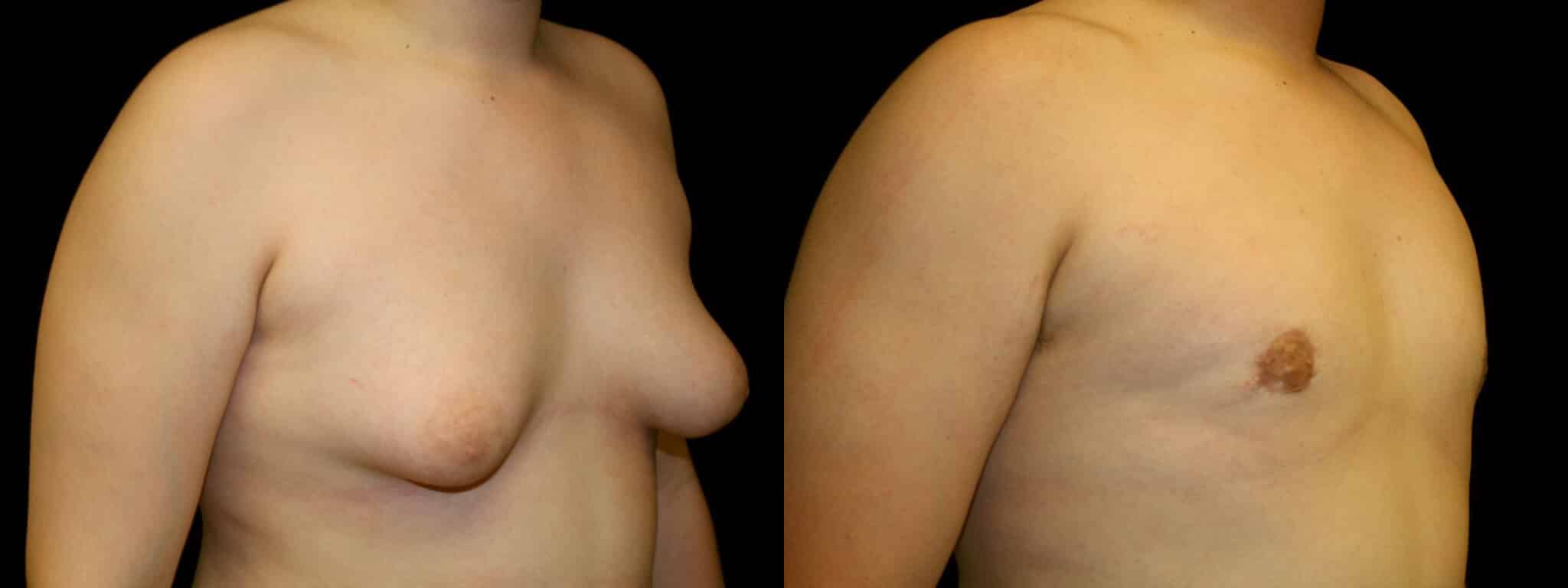 Gynecomastia Patient 2 Before & After Details