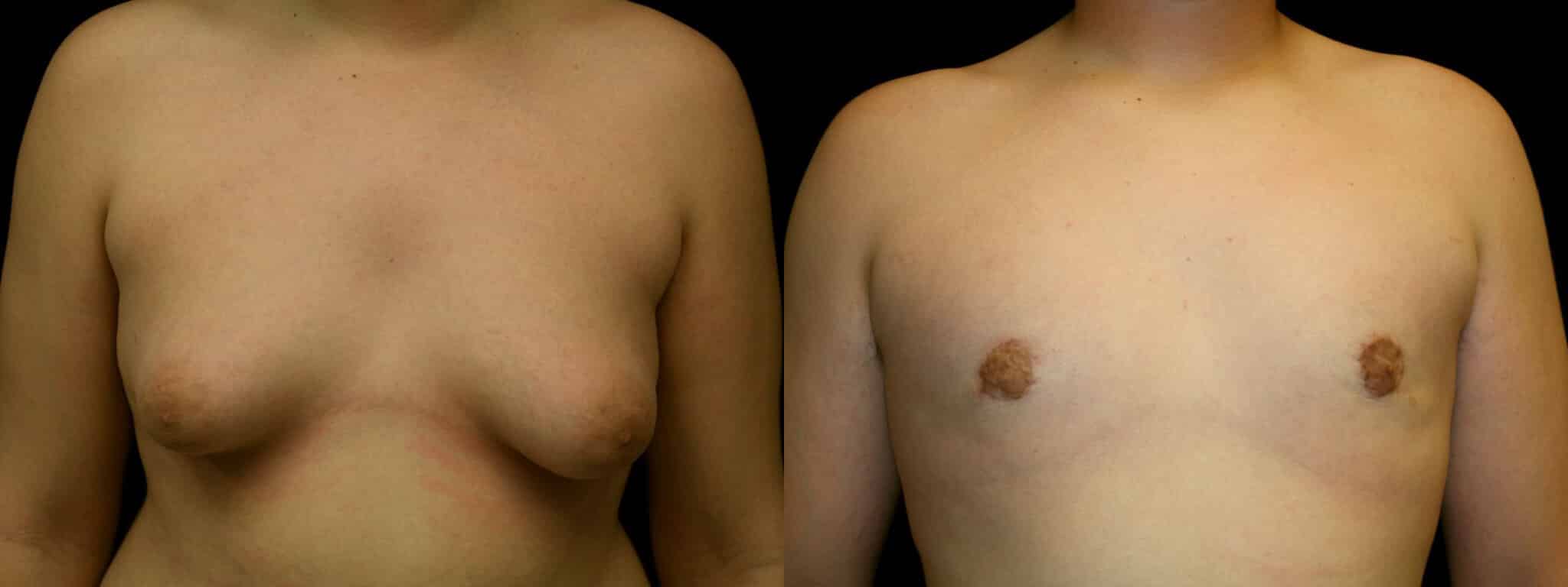 Gynecomastia Patient 2 Before & After