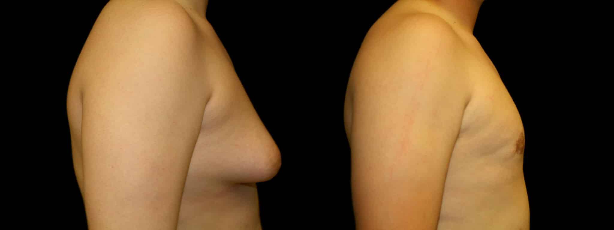 Gynecomastia Patient 2 Before & After Details