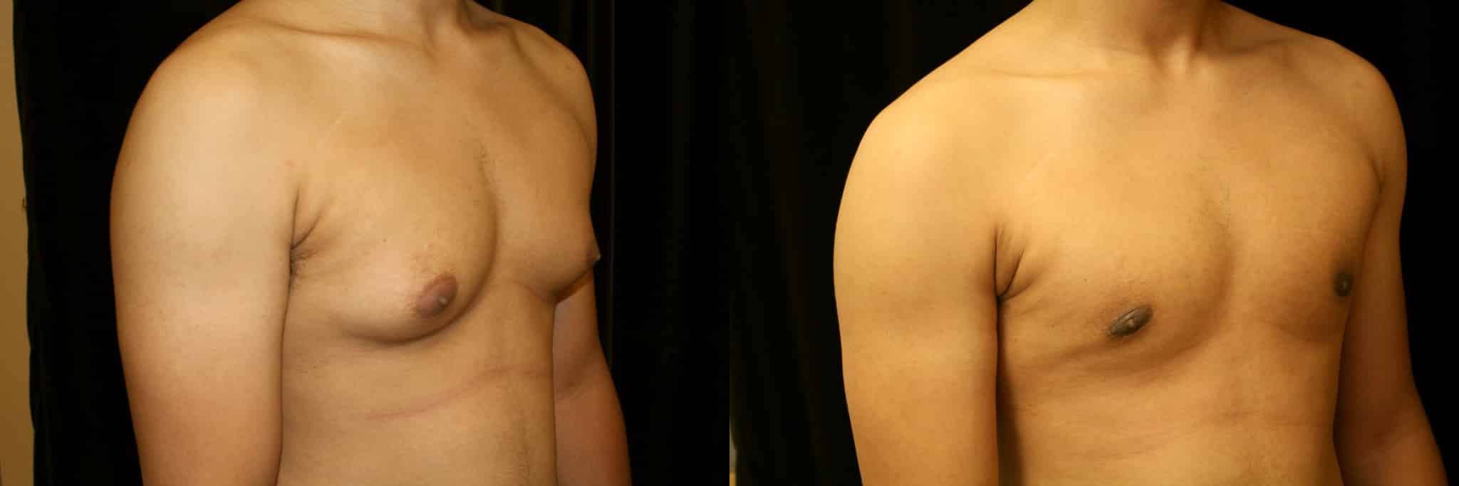 Gynecomastia Patient 2 Before & After Details