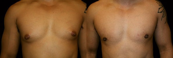 Gynecomastia Patient 1 Before & After