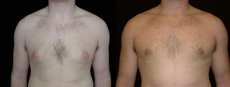 Gynecomastia Patient 7 Before & After