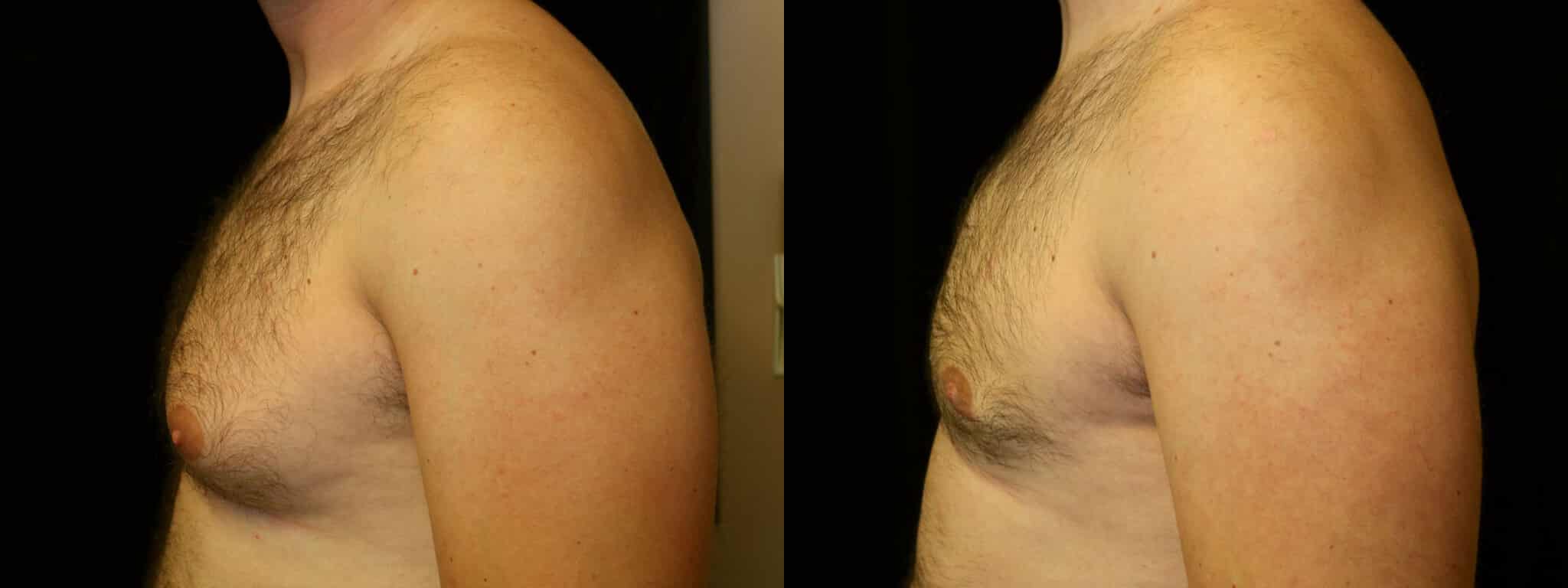 Gynecomastia Patient 1 Before & After Details