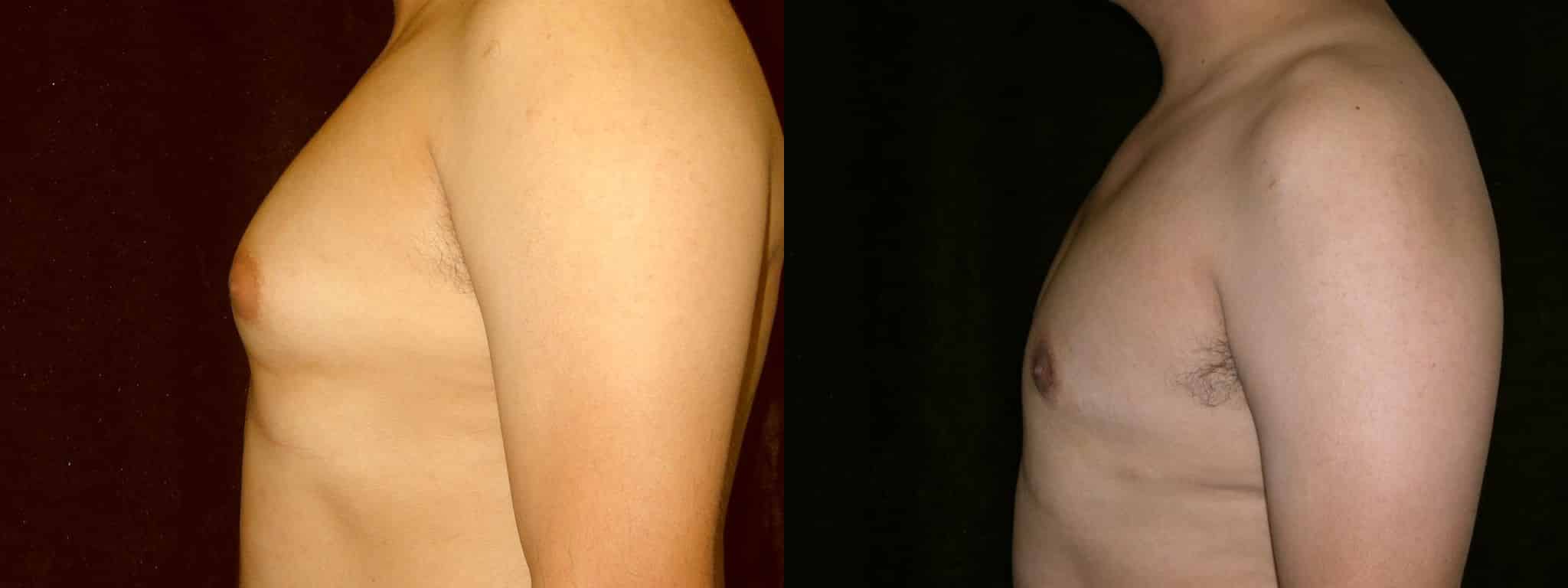 Gynecomastia Patient 18 Before & After Details