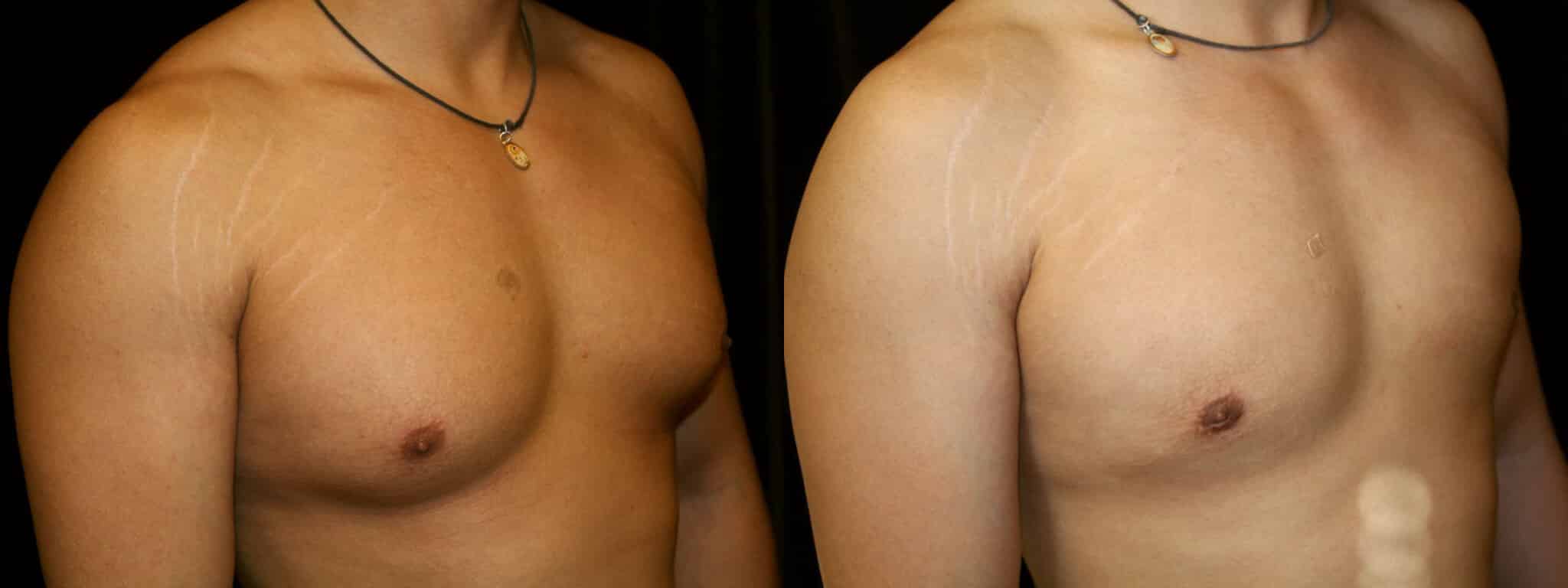 Gynecomastia Patient 14 Before & After Details