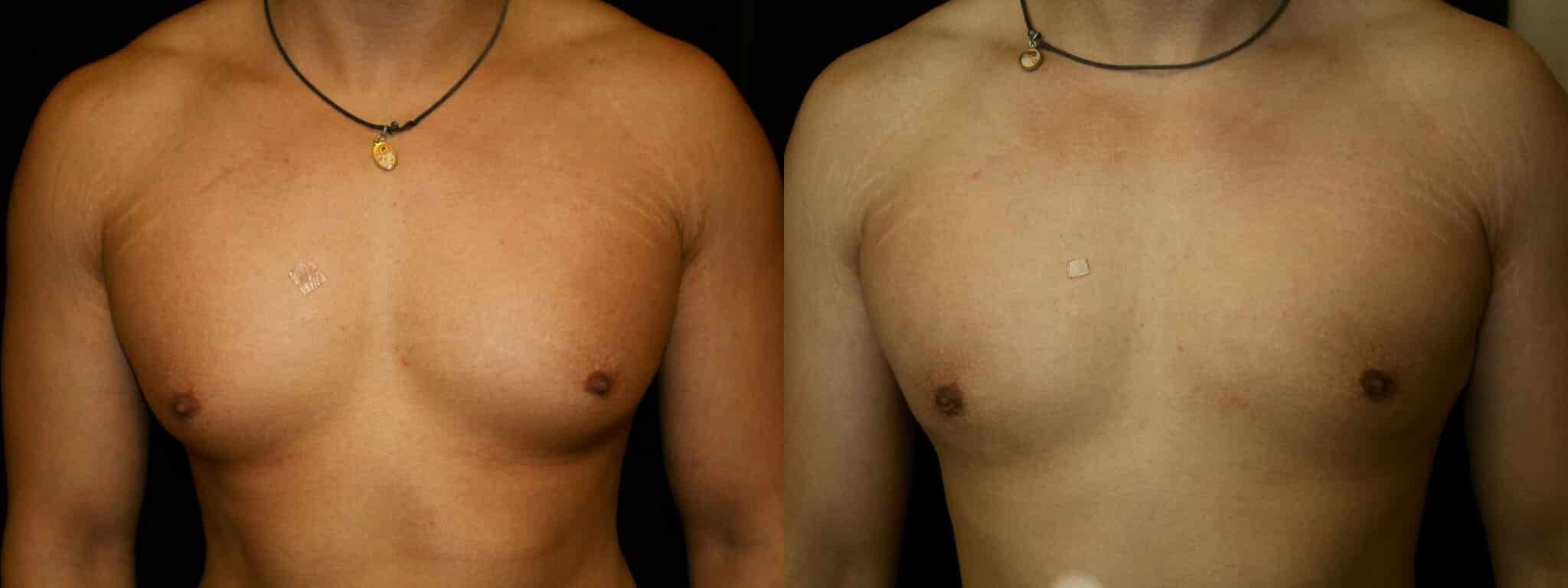 Gynecomastia Patient 14 Before & After