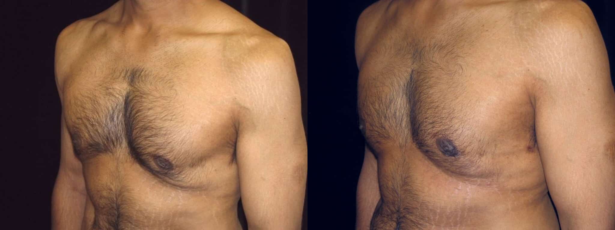 Gynecomastia Patient 5 Before & After Details