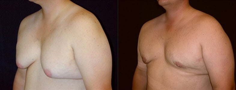 Gynecomastia Patient 11 Before & After