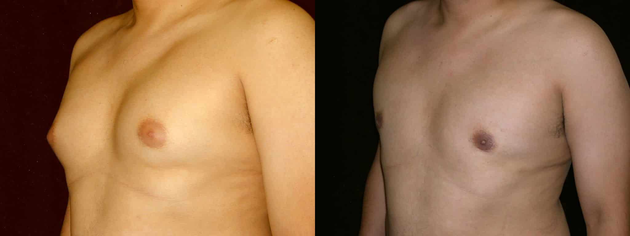 Gynecomastia Patient 18 Before & After Details