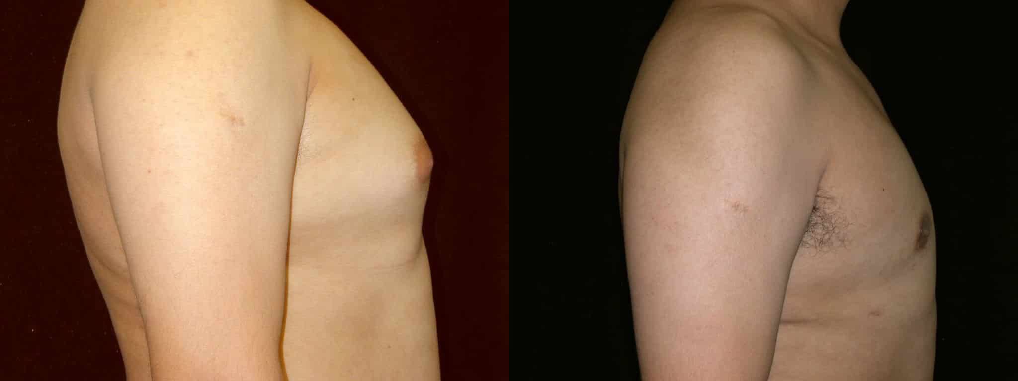 Gynecomastia Patient 18 Before & After Details