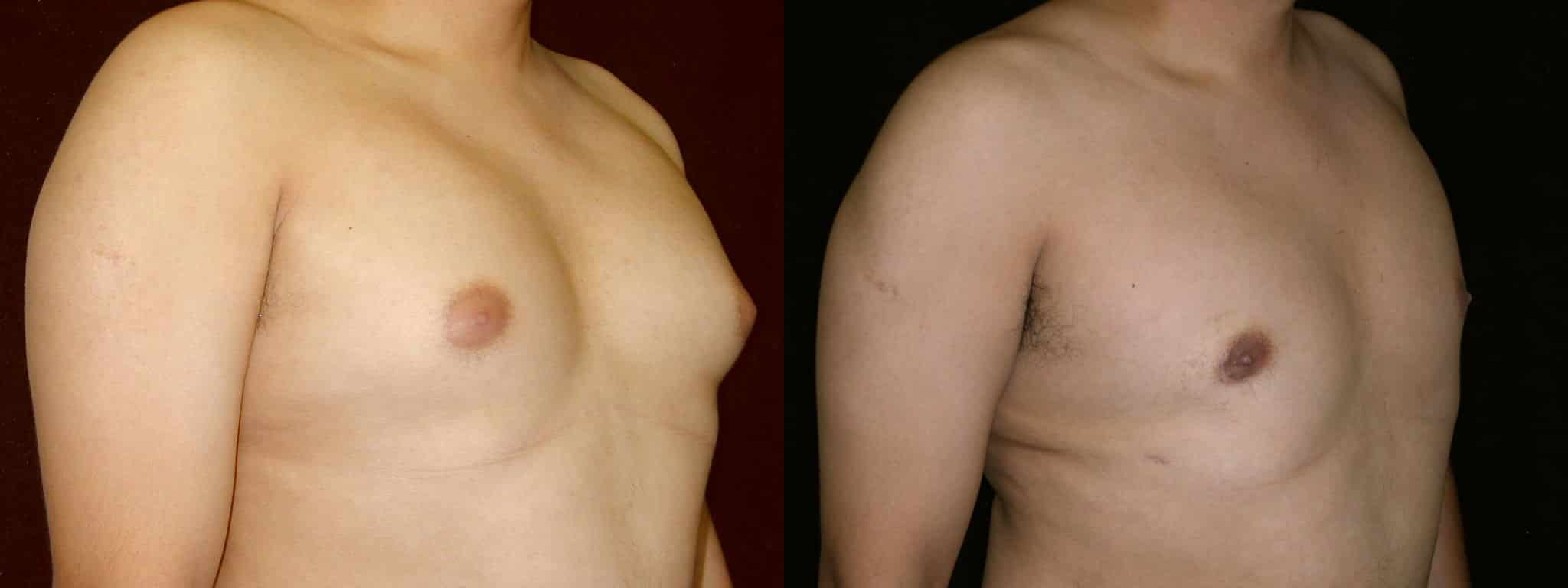 Gynecomastia Patient 18 Before & After Details